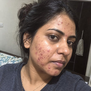 Hormonal Acne