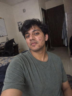 Persistent Adult Acne