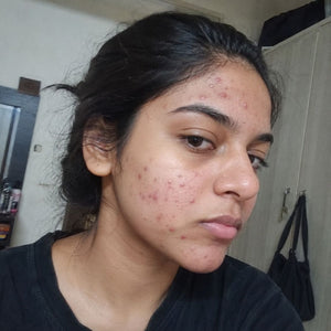Teen Acne