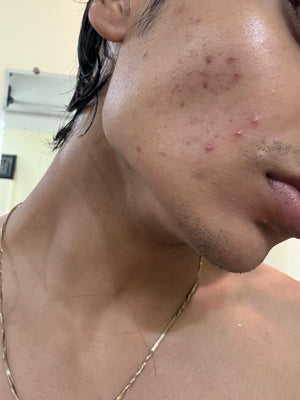 Acne + Marks